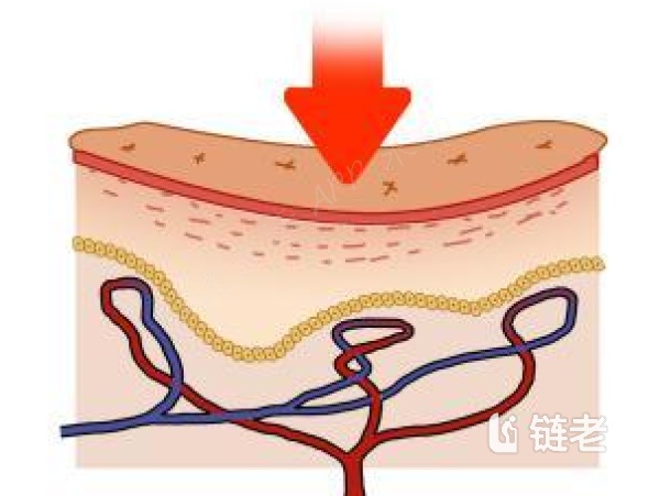 什么是压疮,如何预防? - 链老